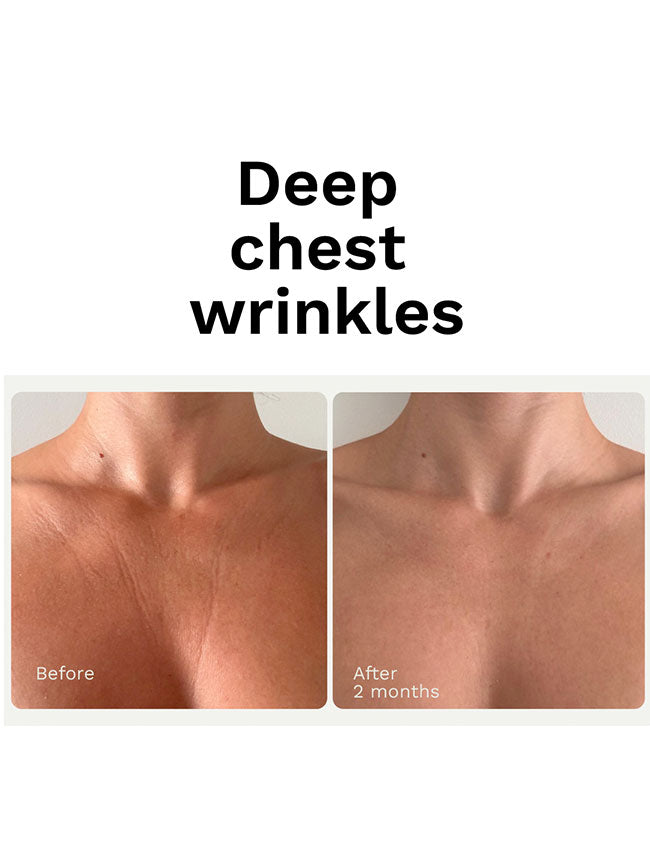Before and after comparison of deep chest wrinkles with text indicating a 2-month time frame with adiepeau stregnt gel