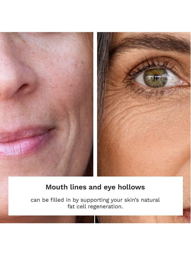 Before and after Adipeau Volume Cream, mouth lines recede after 4 months of daily use