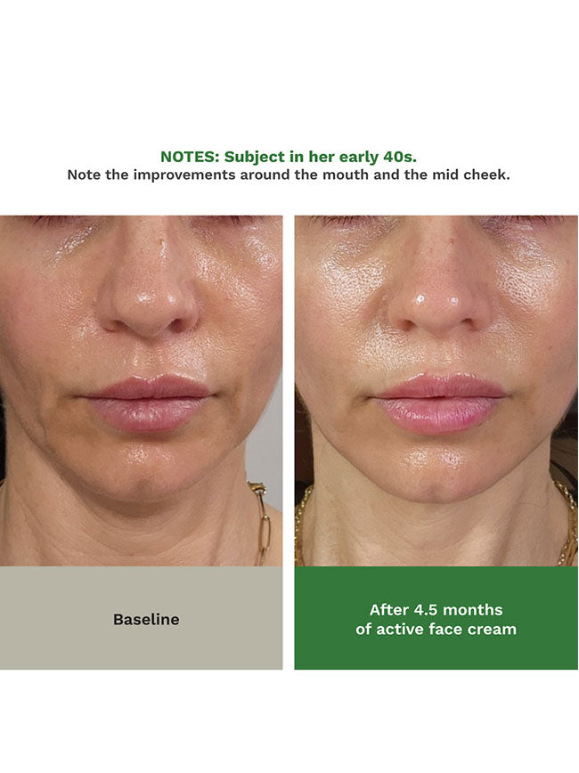 Before and after Adipeau Volume Cream, nasolabial folds strengthen after 1 month