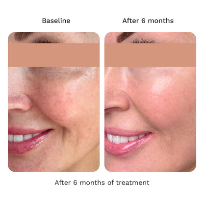 Before-and-after facial skin comparison showing the side of a woman&