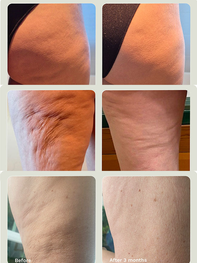 Before and after Adipeau Strength Gel, cellulite on thigh visibly reduced after 3 months of twice daily use